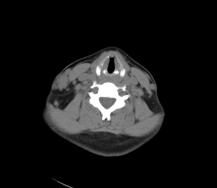 File:Cervical venous malformation (Radiopaedia 22653-22672 Axial non-contrast 37).jpg