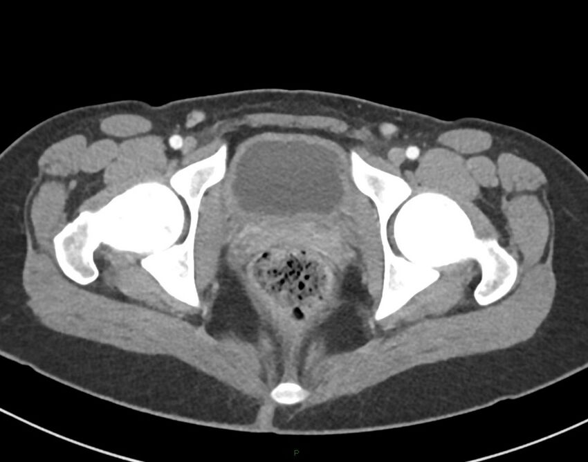 Cesarean scar endometriosis (Radiopaedia 82925-97262 A 84).jpg