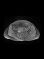 Cesarean section scar endometrioma (Radiopaedia 56569-63297 Axial PD fat sat 18).jpg