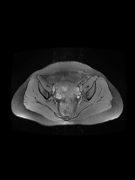 File:Cesarean section scar endometrioma (Radiopaedia 56569-63297 Axial PD fat sat 20).jpg