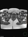 Cesarian scar endometriosis (Radiopaedia 68495-78066 Axial T1 22).jpg