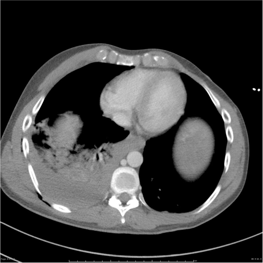 Chest and abdomen multi-trauma (Radiopaedia 26294-26426 A 8).jpg