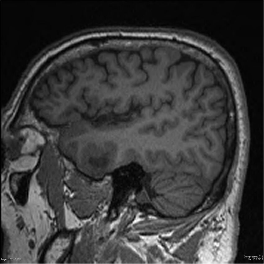 Chondrosarcoma of skull base- grade II (Radiopaedia 40948-43654 Sagittal T1 55).jpg