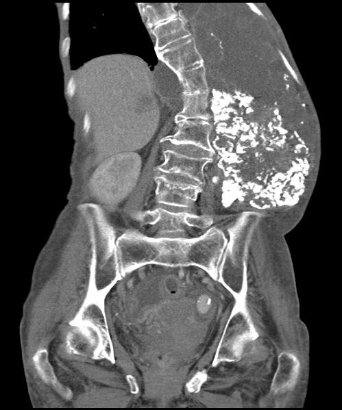 File:Chondrosarcoma of the spine (Radiopaedia 49871-55143 B 12).jpg