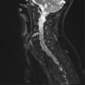 Chordoma (C4 vertebra) (Radiopaedia 47561-52189 Sagittal T2 fat sat 4).png