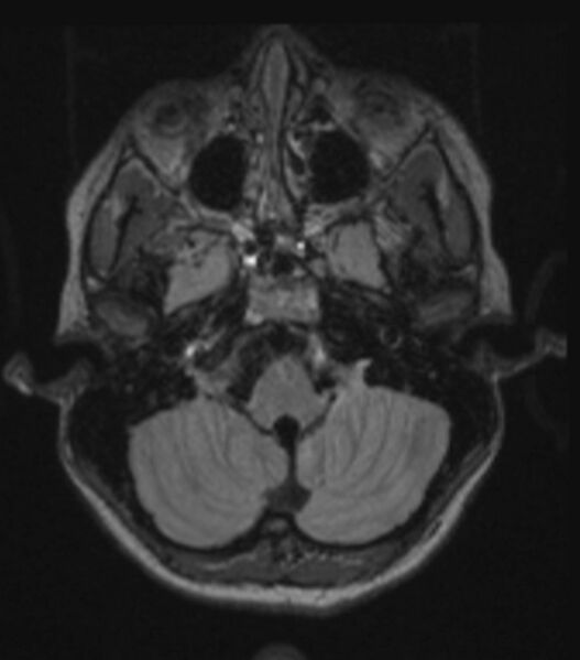 File:Choroid plexus carcinoma (Radiopaedia 91013-108553 Axial FLAIR C+ 87).jpg