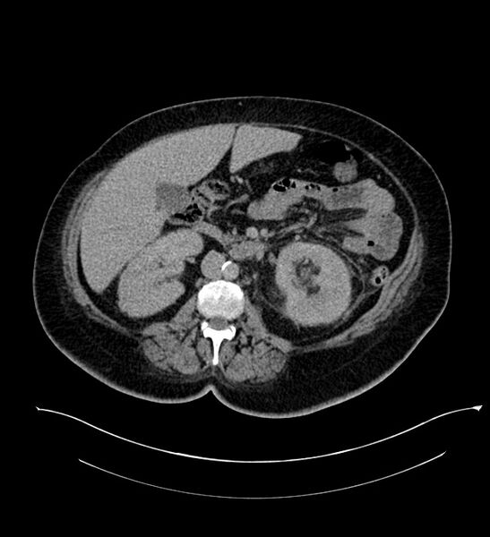 File:Chromophobe renal cell carcinoma (Radiopaedia 84239-99519 E 78).jpg