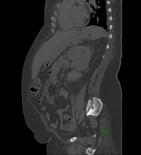 File:Chromophobe renal cell carcinoma (Radiopaedia 84239-99519 Sagittal bone window 39).jpg