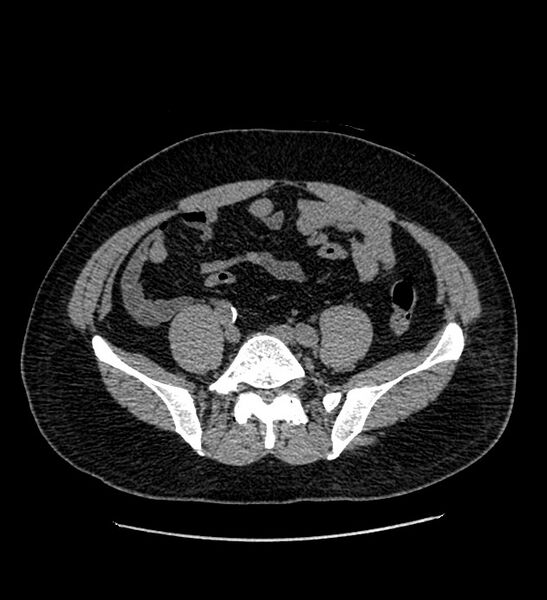 File:Chromophobe renal cell carcinoma (Radiopaedia 84337-99693 Axial non-contrast 109).jpg
