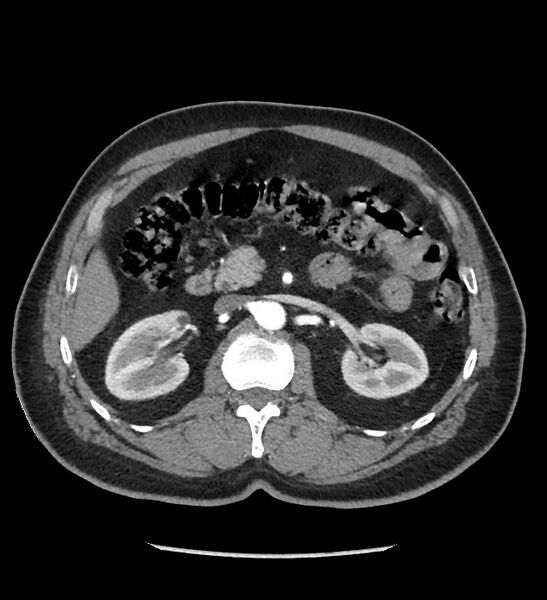 File:Chromophobe renal cell carcinoma (Radiopaedia 86879-103083 B 56).jpg