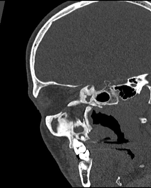 File:Chronic maxillary sinusitis caused by a foreign body (Radiopaedia 58521-65676 Sagittal bone window 46).jpg