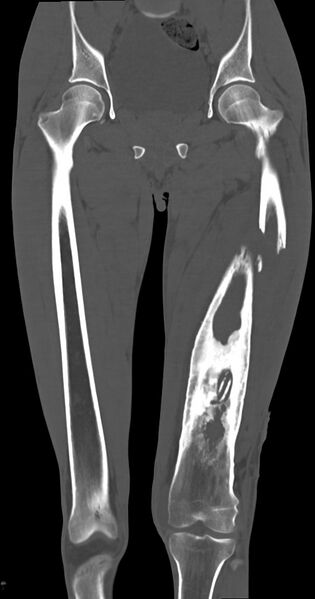 File:Chronic osteomyelitis (with sequestrum) (Radiopaedia 74813-85822 Coronal non-contrast 25).jpg
