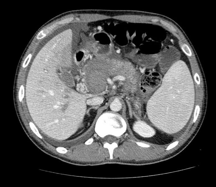 File:Chronic pancreatitis (Radiopaedia 11313-11677 G 1).jpg