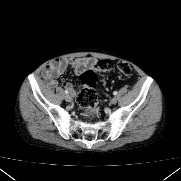 File:Chronic pancreatitis (Radiopaedia 23132-23172 B 57).jpg
