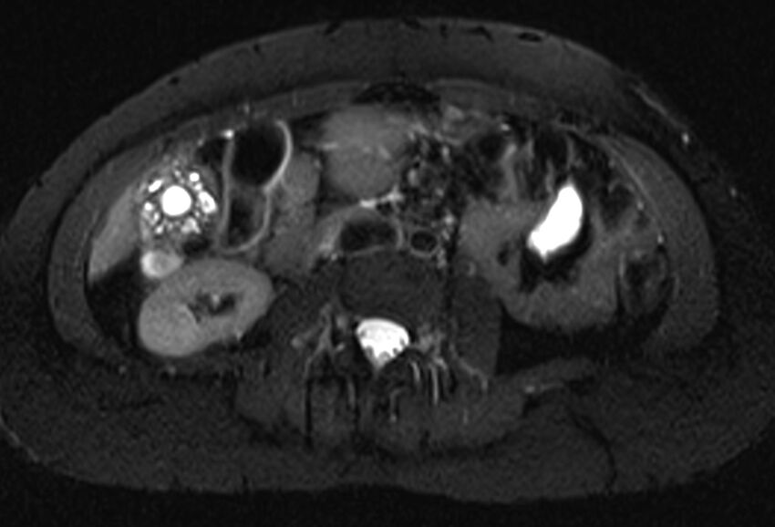 Chronic pancreatitis - pancreatic duct calculi (Radiopaedia 71818-82250 Axial T2 fat sat 42).jpg