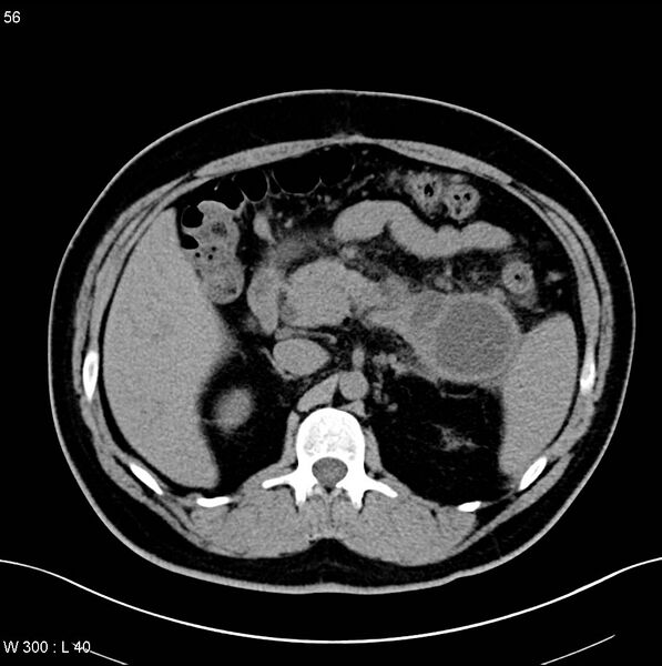 File:Chronic pancreatitis and pseudocysts (Radiopaedia 6724-7935 Axial non-contrast 8).jpg