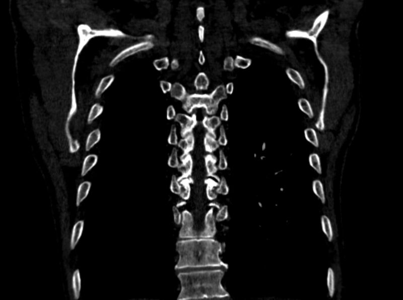 File:Chronic pulmonary embolism (Radiopaedia 91241-108843 A 96).jpg