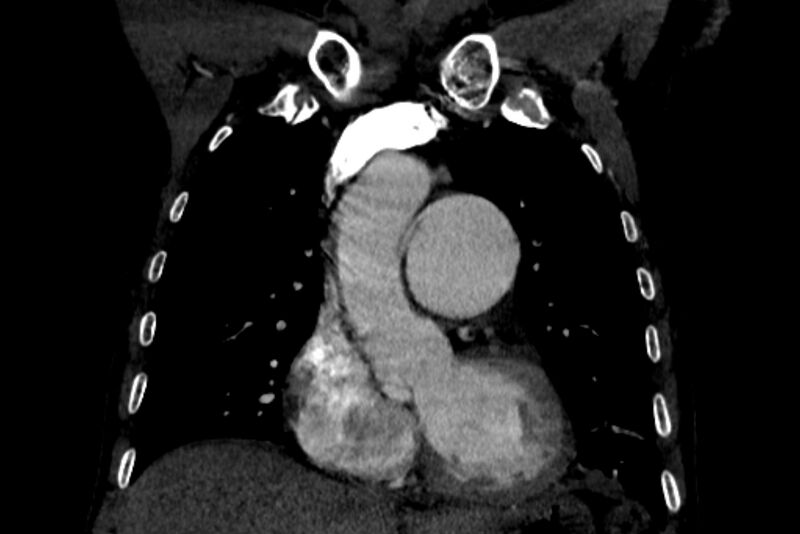 File:Chronic pulmonary embolism with bubbly consolidation (Radiopaedia 91248-108850 B 52).jpg