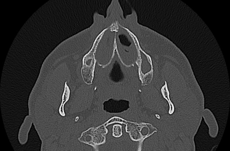 File:Chronic rhinosinusitis (Radiopaedia 65079-74075 Axial bone window 7).jpg