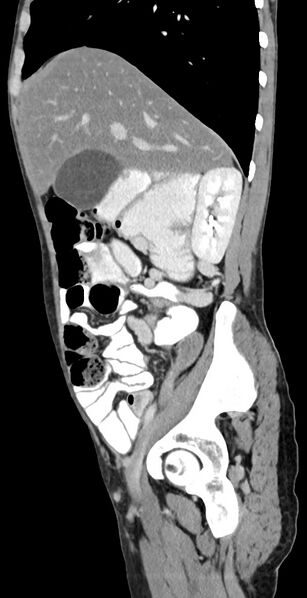 File:Chronic small bowel volvulus (Radiopaedia 75224-86322 C 102).jpg