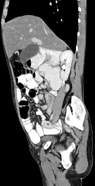 File:Chronic small bowel volvulus (Radiopaedia 75224-86322 C 95).jpg