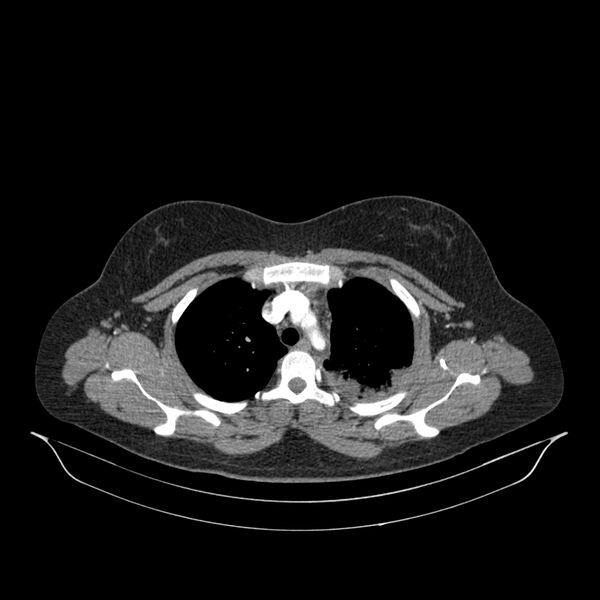 File:Chronic thromboembolic pulmonary hypertension (CTEPH) (Radiopaedia 74597-85532 Axial C+ CTPA 123).jpg