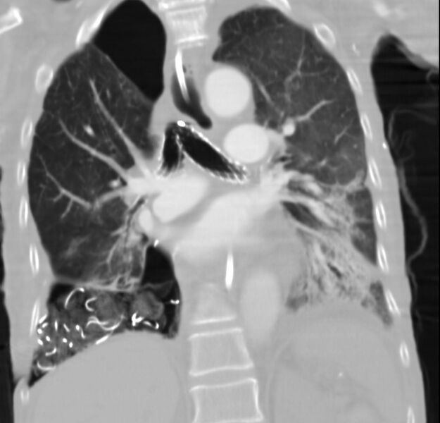 File:Clagett thoracotomy with bronchopleural fistula (Radiopaedia 29192-29587 Coronal lung window 14).jpg