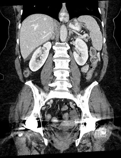 File:Closed loop small bowel obstruction - adhesions (Radiopaedia 59078-66369 B 76).jpg