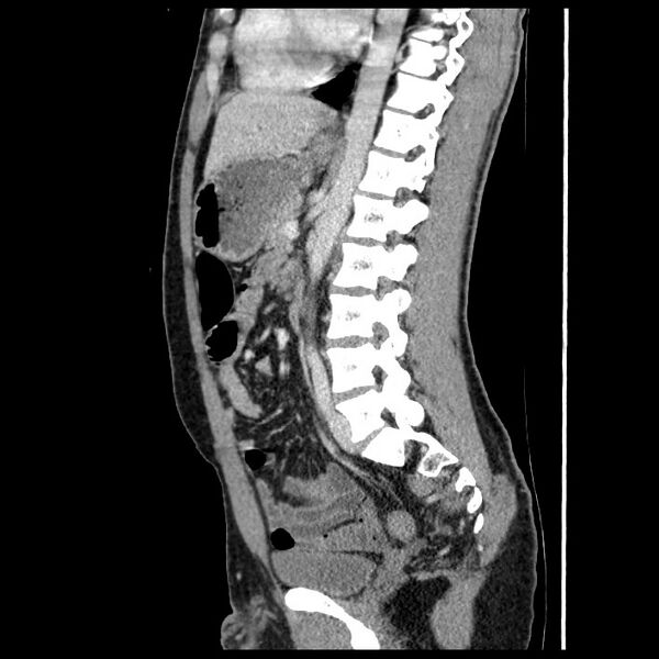 File:Co-existing acute appendicitis and epiploic appendagitis (Radiopaedia 61789-69911 B 53).jpg