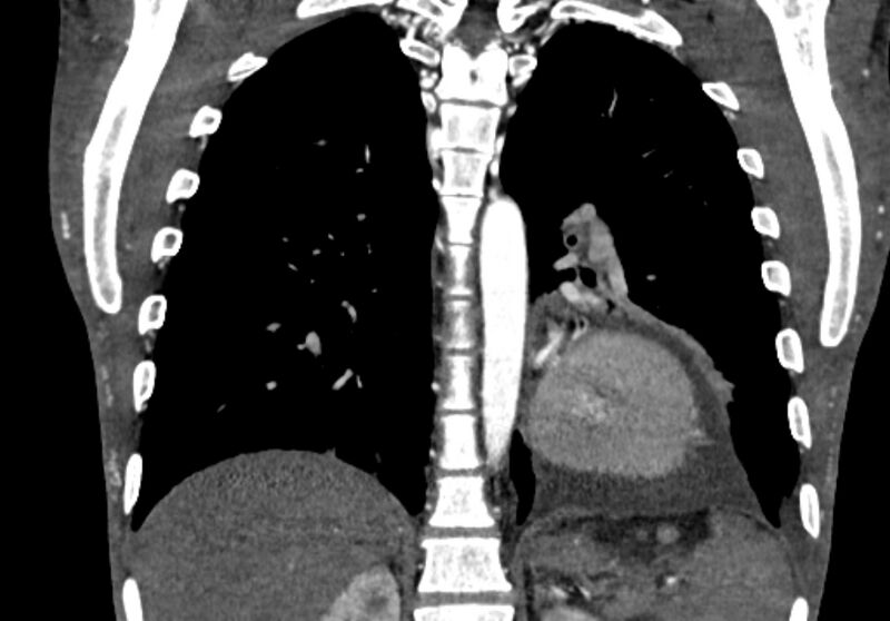 File:Coarctation of aorta with aortic valve stenosis (Radiopaedia 70463-80574 C 169).jpg