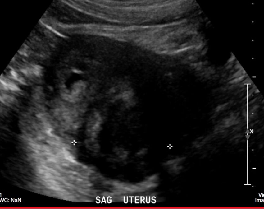 Figure 11.1A Sagittal Ultrasound of the Uterus with a uterine mass.jpg