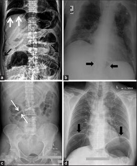 a) X-ray of abdomen, showing subdiaphragmatic free air, air outlining the properitoneal fat stripe black arrows b) Cupola sign arrowheads c) Rigler's sign d) chest radiograph showing free air under the diaphragms
