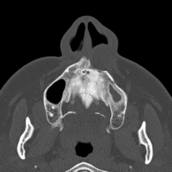 File:Nasolabial cyst (Radiopaedia 33987-35205 Axial bone window 7).jpg