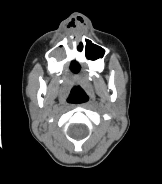 File:Nasoorbitoethmoid fracture (Radiopaedia 90044-107205 Axial non-contrast 103).jpg