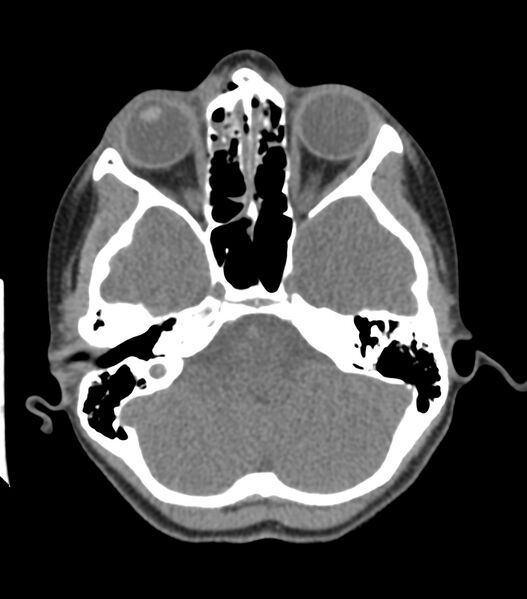 File:Nasoorbitoethmoid fracture (Radiopaedia 90044-107205 Axial non-contrast 157).jpg