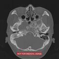 Nasopharyngeal carcinoma recurrence - skull base destruction (Radiopaedia 29107-29490 Axial bone window 86).jpg