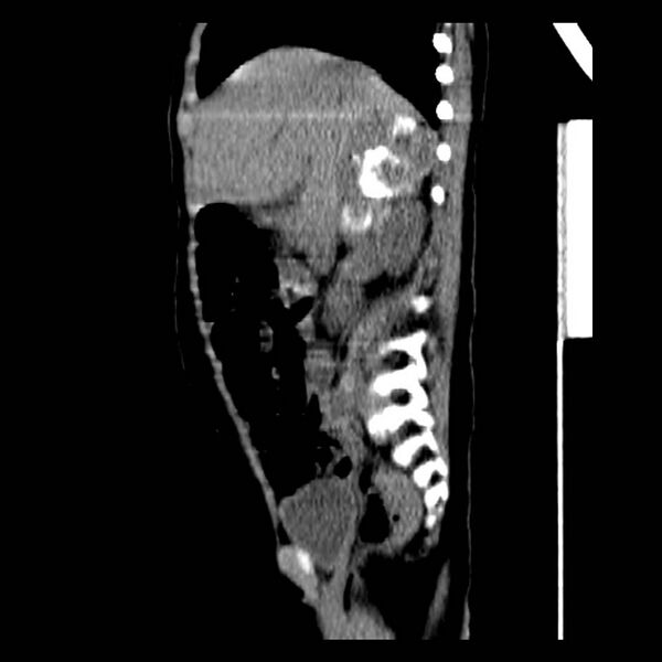 File:Neuroblastoma with skull metastases (Radiopaedia 30326-30960 B 16).jpg