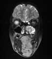 Neurofibromatosis type 1 (Radiopaedia 6954-8063 Coronal T2 1).jpg