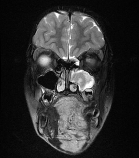 File:Neurofibromatosis type 1 (Radiopaedia 6954-8063 Coronal T2 1).jpg