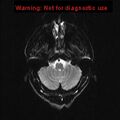 Neuroglial cyst (Radiopaedia 10713-11184 Axial DWI 19).jpg