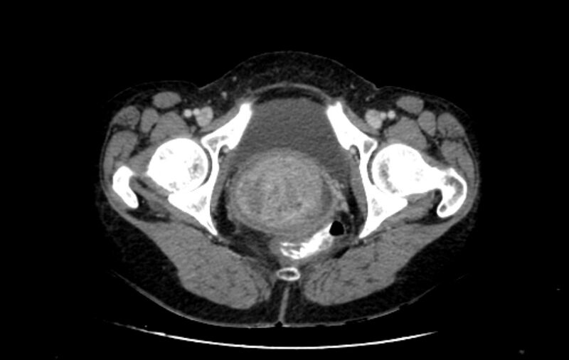 File:Non-puerperal uterine inversion (Radiopaedia 78343-91094 A 71).jpg