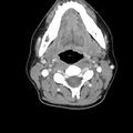 Normal CT of the neck (Radiopaedia 14575-14500 Axial C+ 33).jpg