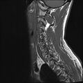Normal cervical spine MRI (Radiopaedia 38418-40496 Sagittal T1 11).jpg