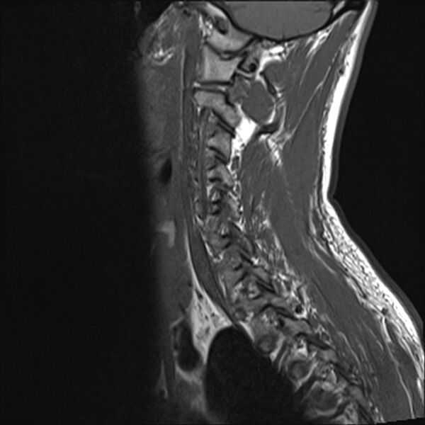 File:Normal cervical spine MRI (Radiopaedia 38418-40496 Sagittal T1 11).jpg