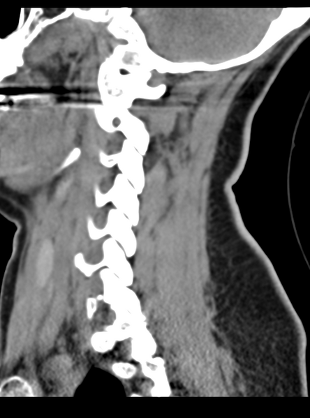 File:Normal cervical spine MRI (including Dixon) (Radiopaedia 42762-45926 C 43).png