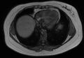 Normal liver MRI with Gadolinium (Radiopaedia 58913-66163 B 30).jpg
