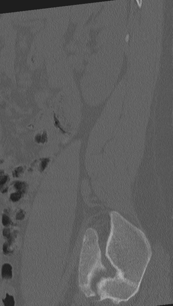 File:Normal lumbar spine CT (Radiopaedia 46533-50986 Sagittal bone window 13).png