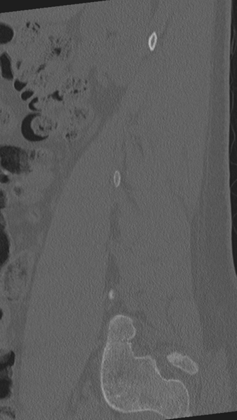 File:Normal lumbar spine CT (Radiopaedia 46533-50986 Sagittal bone window 81).png