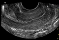 Normal pelvic ultrasound - transvaginal (Radiopaedia 31750-32684 Longitudinal 1).png