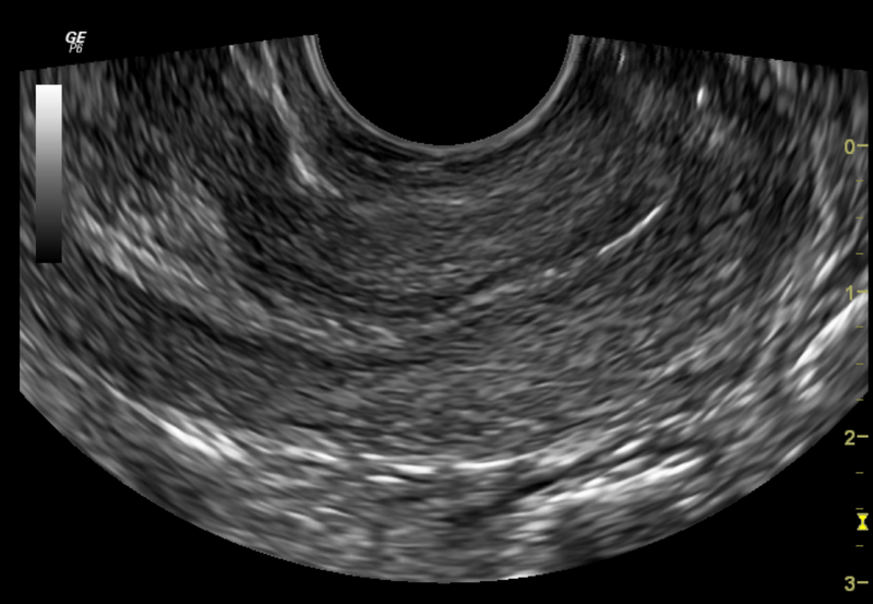 File:Normal pelvic ultrasound - transvaginal (Radiopaedia 31750-32684 Longitudinal 1).png
